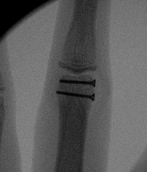 Finger Unicondylar Fracture ORIF AP